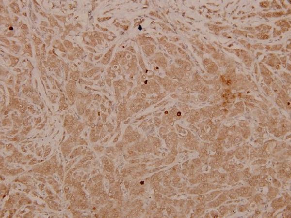 Immunohistochemistry (IHC) analyzes of p-MEK-4/ MAP2K4 (T261) pAb in paraffin-embedded human breast carcinoma tissue at 1:100