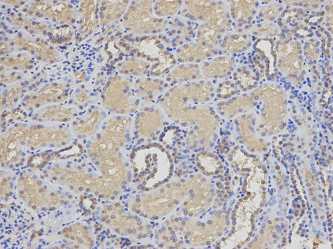 Immunohistochemistry of paraffin-embedded human breast cancer using eIF5A Rabbit pAb  at dilution of 1:25 