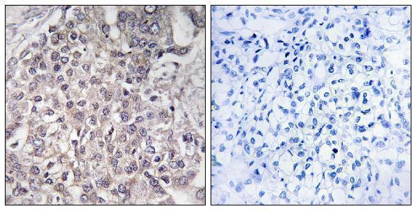 Immunohistochemistry analysis of paraffin-embedded human liver carcinoma, using Cytochrome P450 4F2 Antibody