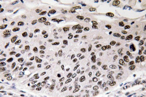 Immunohistochemistry (IHC) analyzes of Cyclin D3 (G277) pAb in paraffin-embedded human lung carcinoma tissue