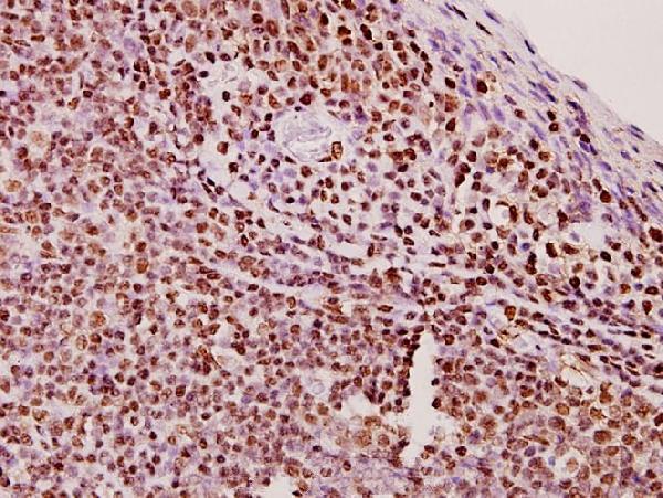 Immunohistochemistry (IHC) analyzes of ERCC5/XPG (E160) pAb in paraffin-embedded human tonsil carcinoma tissue at 1:50