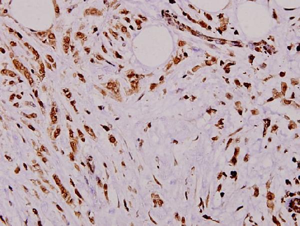 Immunohistochemistry (IHC) analyzes of TRα (A19) pAb in paraffin-embedded human breast carcinoma tissue at 1:100