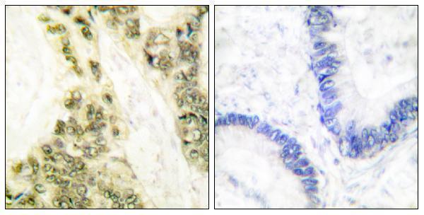 Immunohistochemistry analysis of paraffin-embedded human colon carcinoma tissue, using Thyroid Hormone Receptor alpha Antibody
