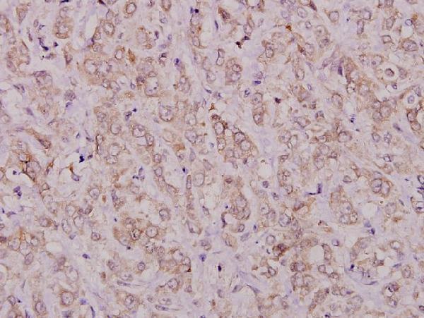 Immunohistochemistry (IHC) analyzes of TGFα (R139) pAb in paraffin-embedded human breast carcinoma tissue at 1:100