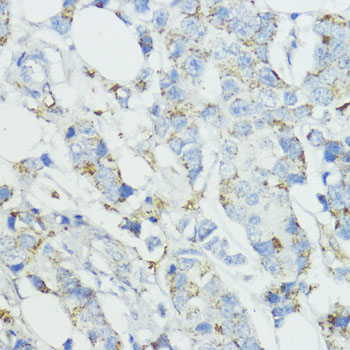 Immunohistochemistry of paraffin-embedded human mammary cancer using SOD3 antibody  at dilution of 1:100 