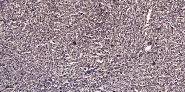 Immunohistochemical analysis of paraffin-embedded human liver cancer