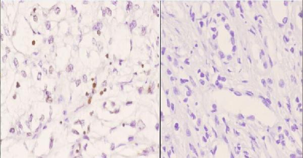Immunohistochemistry (IHC) analyzes of TFE3 pAb in paraffin-embedded human kidney carcinoma tissue at 1:50