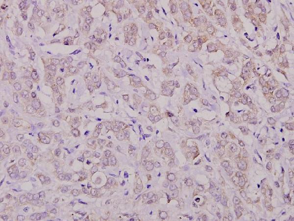Immunohistochemistry (IHC) analyzes of p-PKC ζ (T410) pAb in paraffin-embedded human breast carcinoma tissue at 1:100