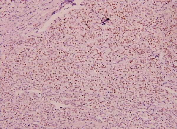 Immunohistochemistry (IHC) analyzes of p-MEF2D (S444) pAb in paraffin-embedded human liver carcinoma tissue at 1:100