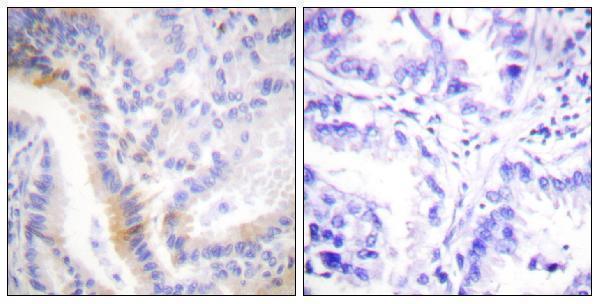 Immunohistochemistry analysis of paraffin-embedded human lung carcinoma tissue, using Urocortin Antibody
