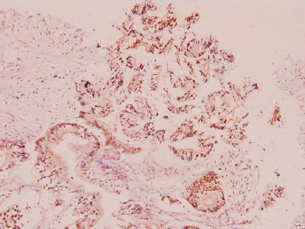 Immunohistochemistry (IHC) analyzes of UCN (A103) pAb in paraffin-embedded human colorectal carcinoma tissue at 1:100