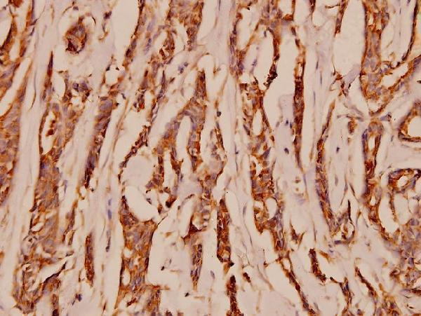 Immunohistochemistry (IHC) analyzes of NMDAζ1 (S885) pAb in paraffin-embedded human breast carcinoma tissue at 1:100