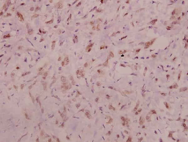 Immunohistochemistry (IHC) analyzes of p-NMDAζ1 (S896) pAb in paraffin-embedded human breast carcinoma tissue at 1:100