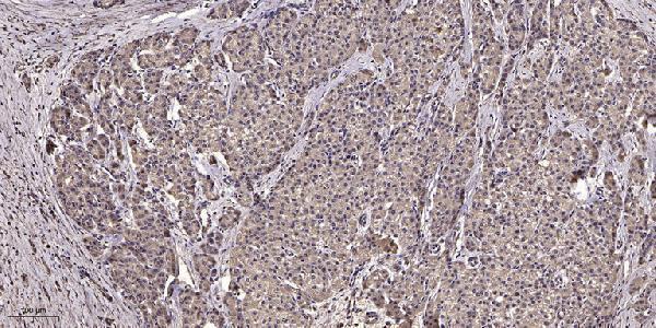 Immunohistochemical analysis of paraffin-embedded human liver cancer