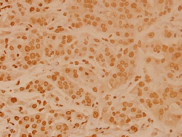Immunohistochemistry (IHC) analyzes of FoxO4 (P191) pAb in paraffin-embedded human breast carcinoma tissue at 1:100
