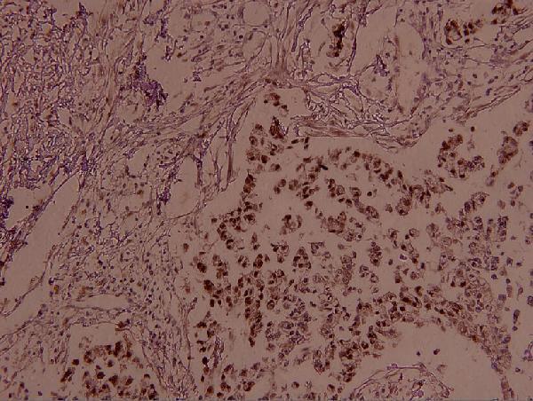 Immunohistochemistry (IHC) analyzes of p-JunB (S259) pAb in paraffin-embedded human breast carcinoma tissue at 1:100