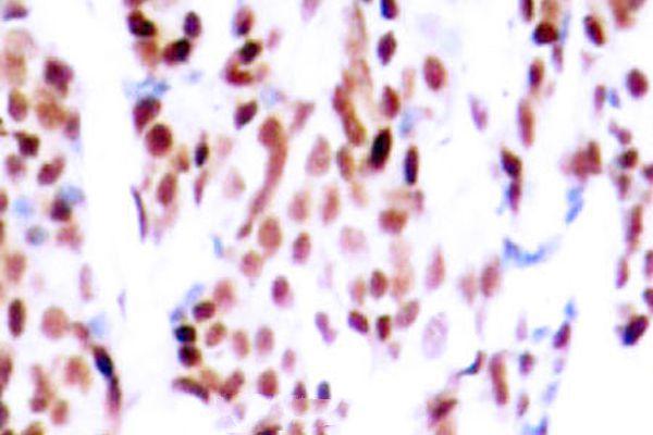Immunohistochemistry (IHC) analysis of p-JunB (S79) pAb in paraffin-embedded human breast carcinoma tissue