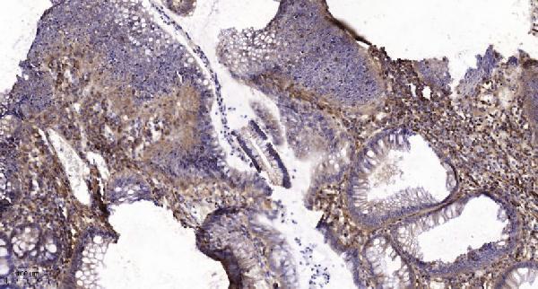 Immunohistochemical analysis of paraffin-embedded human colon cancer