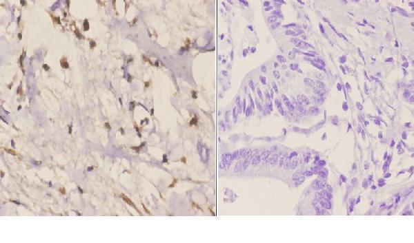 Immunohistochemistry (IHC) analyzes of Rad51C (E185) pAb in paraffin-embedded human colon carcinoma tissue at 1:50