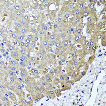 Immunohistochemistry of paraffin-embedded human colon carcinoma using PPOX antibody  at dilution of 1:100 