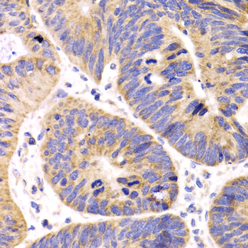 Immunohistochemistry of paraffin-embedded human colon carcinoma using HMGCL antibody  at dilution of 1:100 