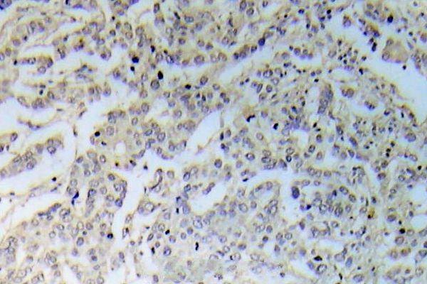 Immunohistochemistry (IHC) analyzes of p-IKK-a/b (S176) pAb in paraffin-embedded human breast carcinoma tissue