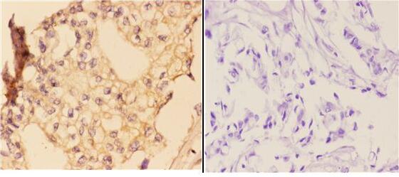 Immunohistochemistry (IHC) analyzes of p-IKKα/β (S176/177) pAb in paraffin-embedded human breast carcinoma tissue at 1:50,showing cytoplasmic and nuclear staining