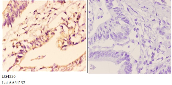 Immunohistochemistry (IHC) analyzes of p-IKKα/β (S176/177) pAb in paraffin-embedded human colon carcinoma tissue at 1:50,showing cytoplasmic and nuclear staining