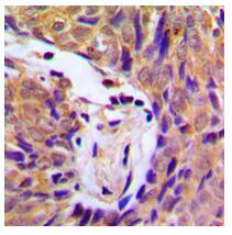 Immunohistochemical analysis of IKK alpha/beta (Phospho-S180/181) staining in human breast cancer formalin fixed paraffin embedded tissue section