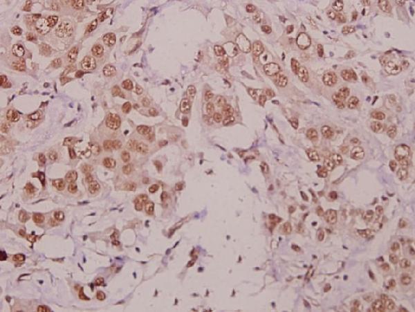 Immunohistochemistry (IHC) analyzes of IKKα (phospho-T23) polyclonal antibody in paraffin-embedded human colorectal carcinoma tissue at 1:50