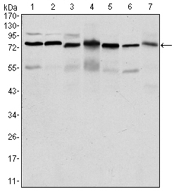 Immunohistochemistry analysis of paraffin-embedded breast cancer tissues (left) and ovarian cancer tissues (right) with DAB staining using LEDGF Monoclonal Antibody