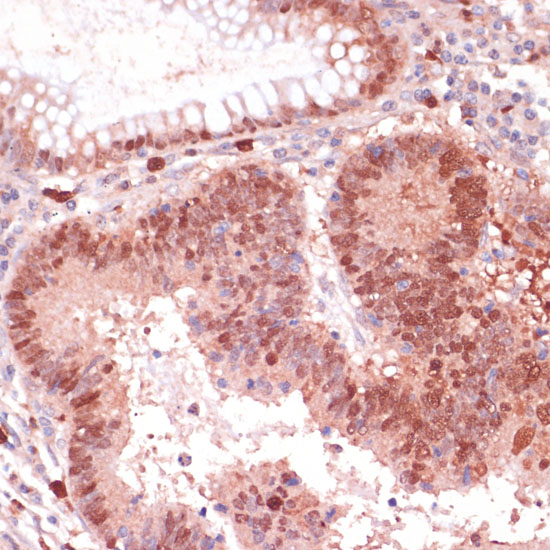 Immunohistochemistry of paraffin-embedded human colon carcinoma using S100P antibody  at dilution of 1:100 