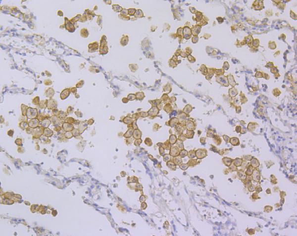 Immunohistochemical analysis of paraffin-embedded human lung cancer tissue using anti-DAP12 antibody
