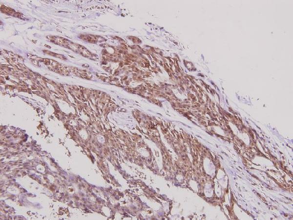 Immunohistochemistry (IHC) analyzes of ERAP1 (K467) pAb in paraffin-embedded human breast carcinoma tissue at 1:100
