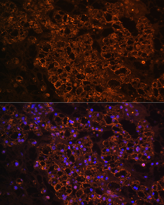Immunofluorescence analysis of human kidney cancer using PCK1 Rabbit pAb  at dilution of 1:100 