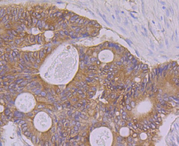 Immunohistochemical analysis of paraffin-embedded human colon cancer tissue using anti-PON2 antibody
