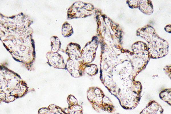 Immunohistochemistry analysis of PEDF antibody in paraffin-embedded human prostate carcinoma tissue