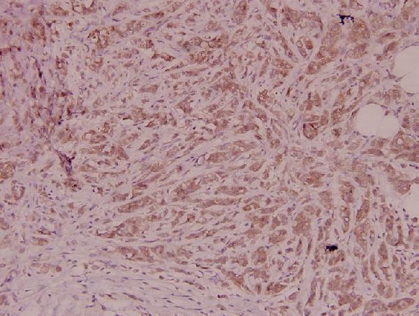 Immunohistochemistry (IHC) analyzes of PEDF (T307) pAb in paraffin-embedded human breast carcinoma tissue at 1:100
