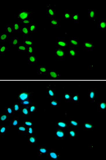 Immunohistochemistry of paraffin-embedded human gastric cancer using RUVBL1/TIP49A/PONTIN Antibody  at dilution of 1:100 
