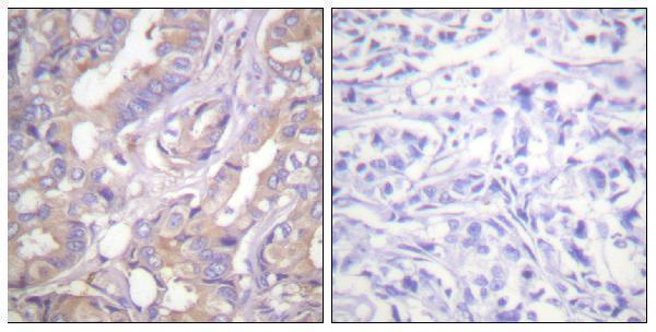 Immunohistochemistry analysis of paraffin-embedded human breast carcinoma tissue, using A-RAF Antibody