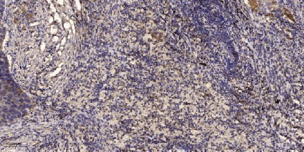 Immunohistochemical analysis of paraffin-embedded human Squamous cell carcinoma of lung