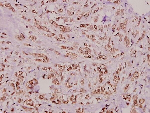 Immunohistochemistry (IHC) analyzes of CrkL (P201) pAb in paraffin-embedded human breast carcinoma tissue at 1:100