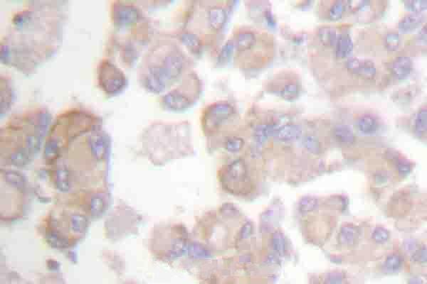 Immunohistochemistry (IHC) analyzes of p-Crk-L (Y207) pAb in paraffin-embedded human colon cancer tissue