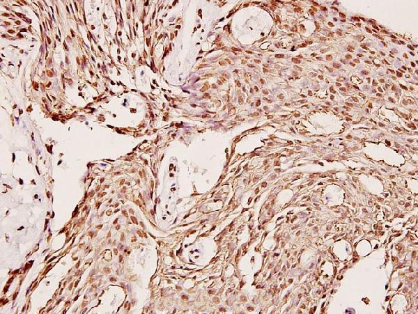 Immunohistochemistry (IHC) analyzes of CYP2C19 (K270) pAb in paraffin-embedded human breast carcinoma tissue at 1:100
