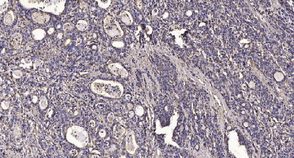 Immunohistochemical analysis of paraffin-embedded human Gastric adenocarcinoma