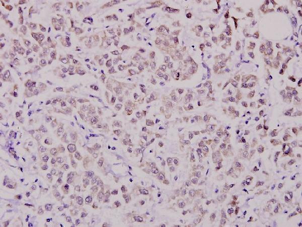 Immunohistochemistry (IHC) analyzes of WAVE1 (I119) pAb in paraffin-embedded human breast carcinoma tissue at 1:100
