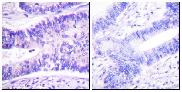 Immunohistochemistry analysis of paraffin-embedded human colon carcinoma, using WAVE1 (Phospho-Tyr125) Antibody