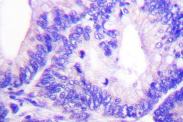 Immunohistochemistry (IHC) analyzes of p-WAVE1 (Y125) pAb in paraffin-embedded human colon carcinoma and lung carcinoma tissue