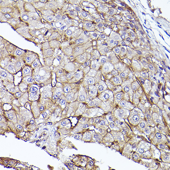 Immunohistochemistry of paraffin-embedded human liver cancer using [KO Validated] CD73/NT5E Rabbit pAb  at dilution of 1:50 