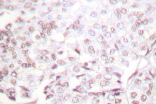 Immunohistochemistry (IHC) analyzes of XRCC2 (F240) pAb in paraffin-embedded human lung carcinoma tissue